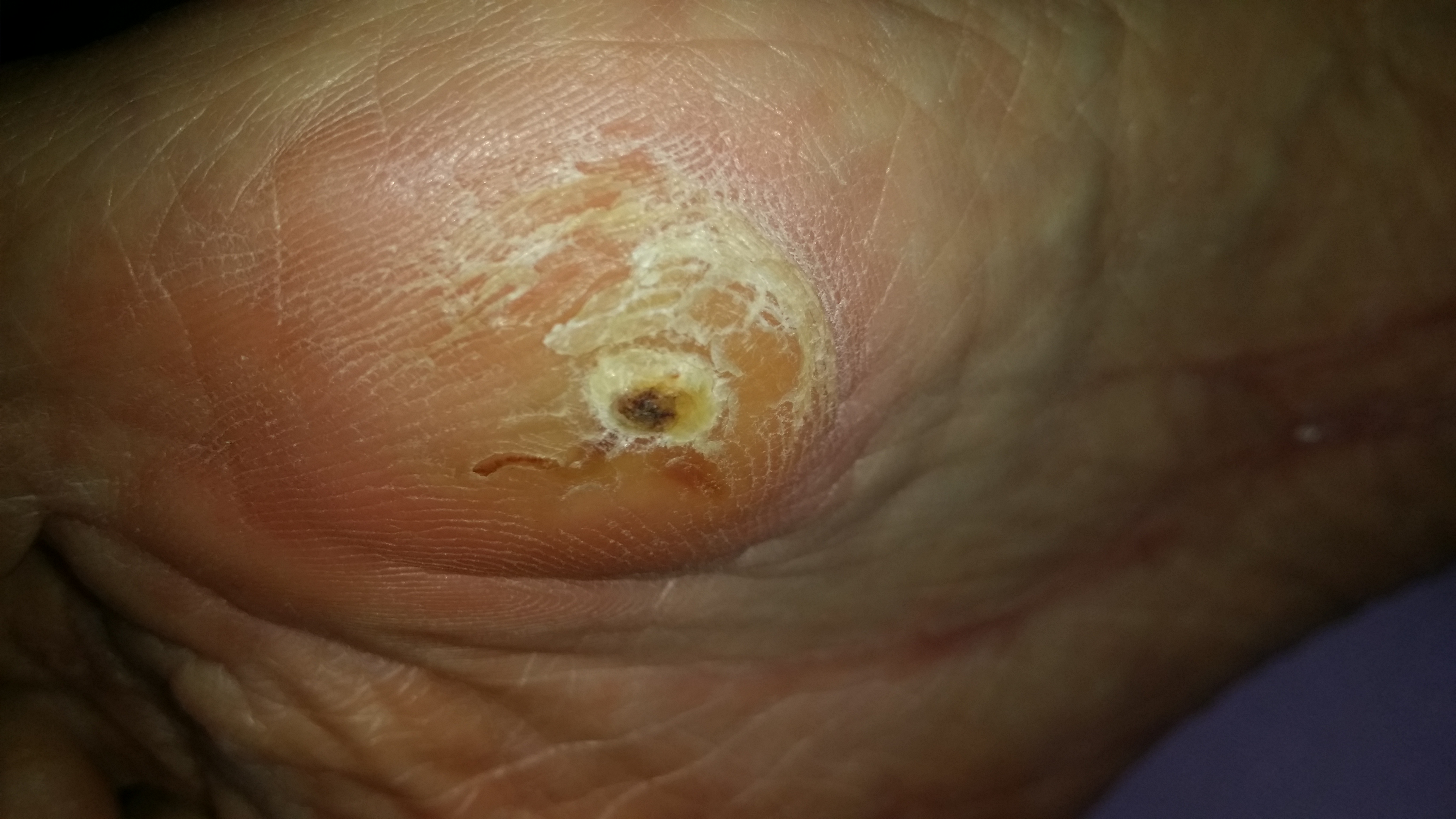 Disseminated superficial actinic porokeratosis | DermNet ...