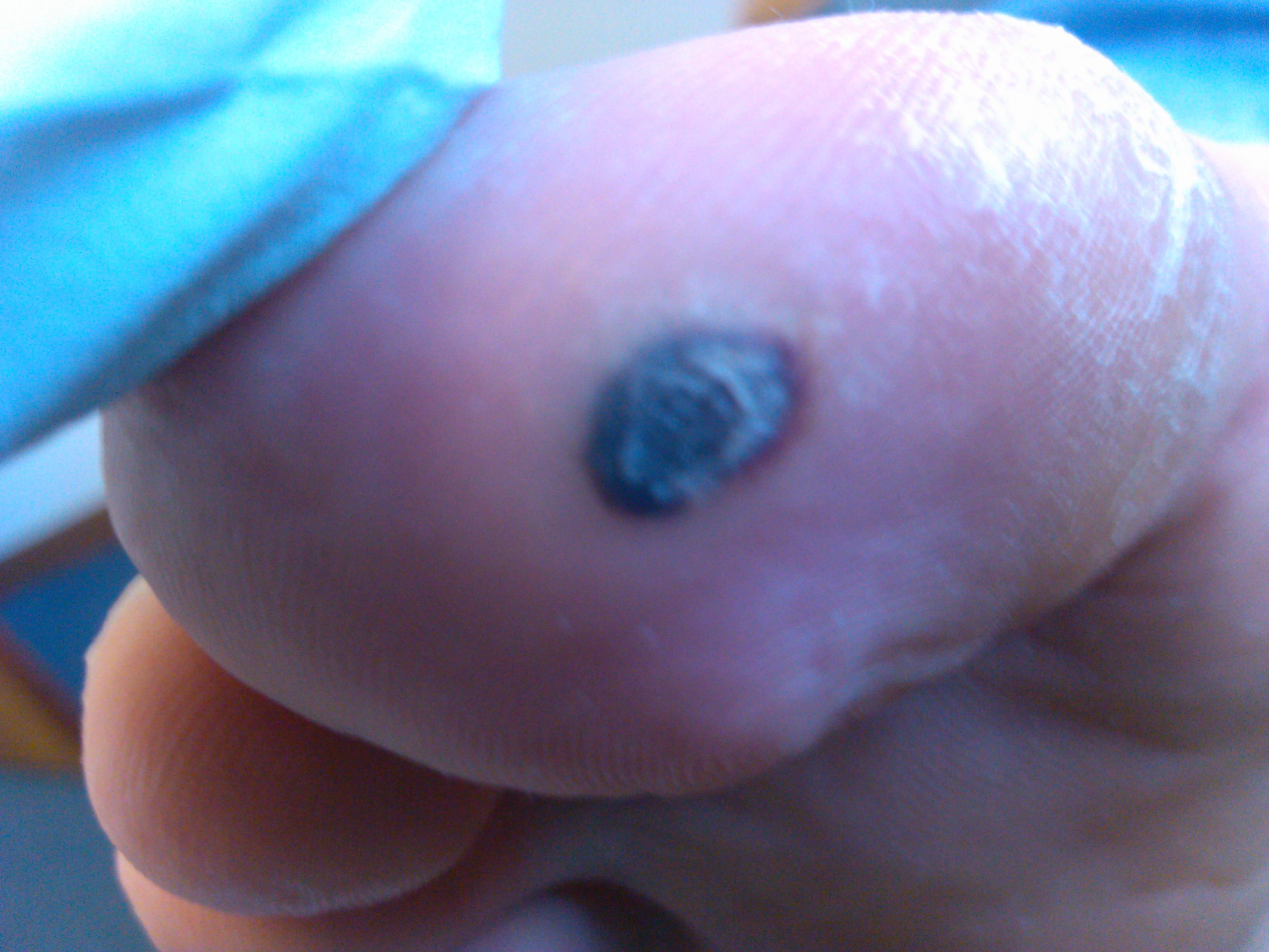 Wart on foot going black, Wart on foot turned black. Wart on foot with black spots - thecroppers.ro