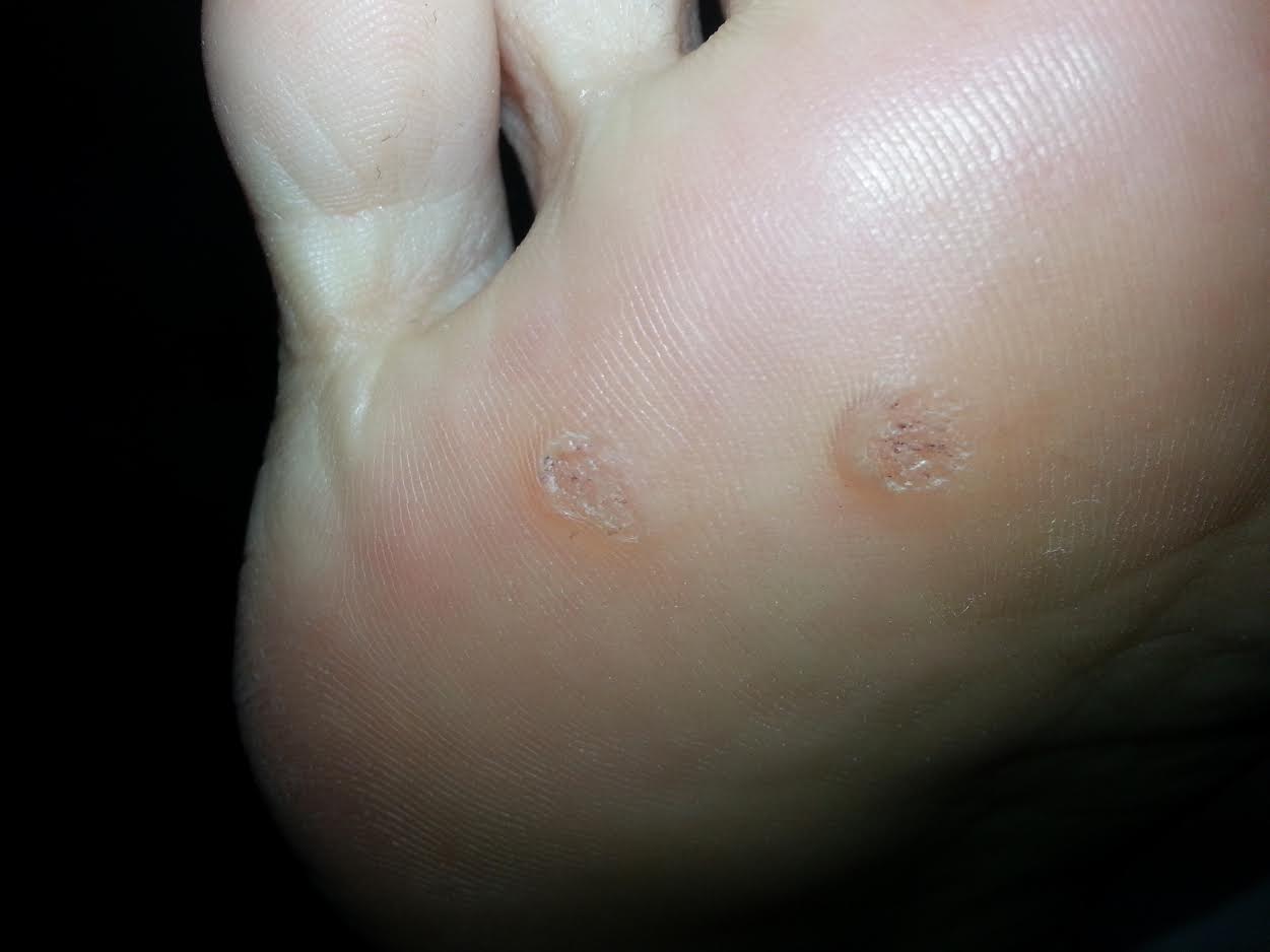 warts on feet #11