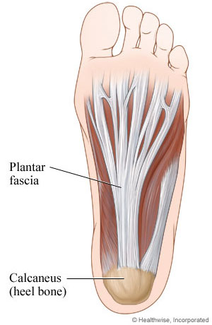 Plantar Fasciitis