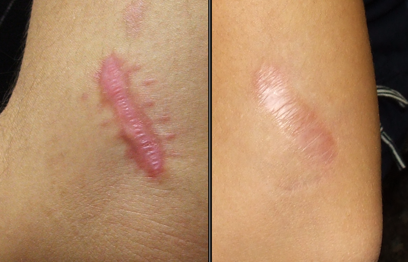 Management of Keloids and Hypertrophic Scars - American ...