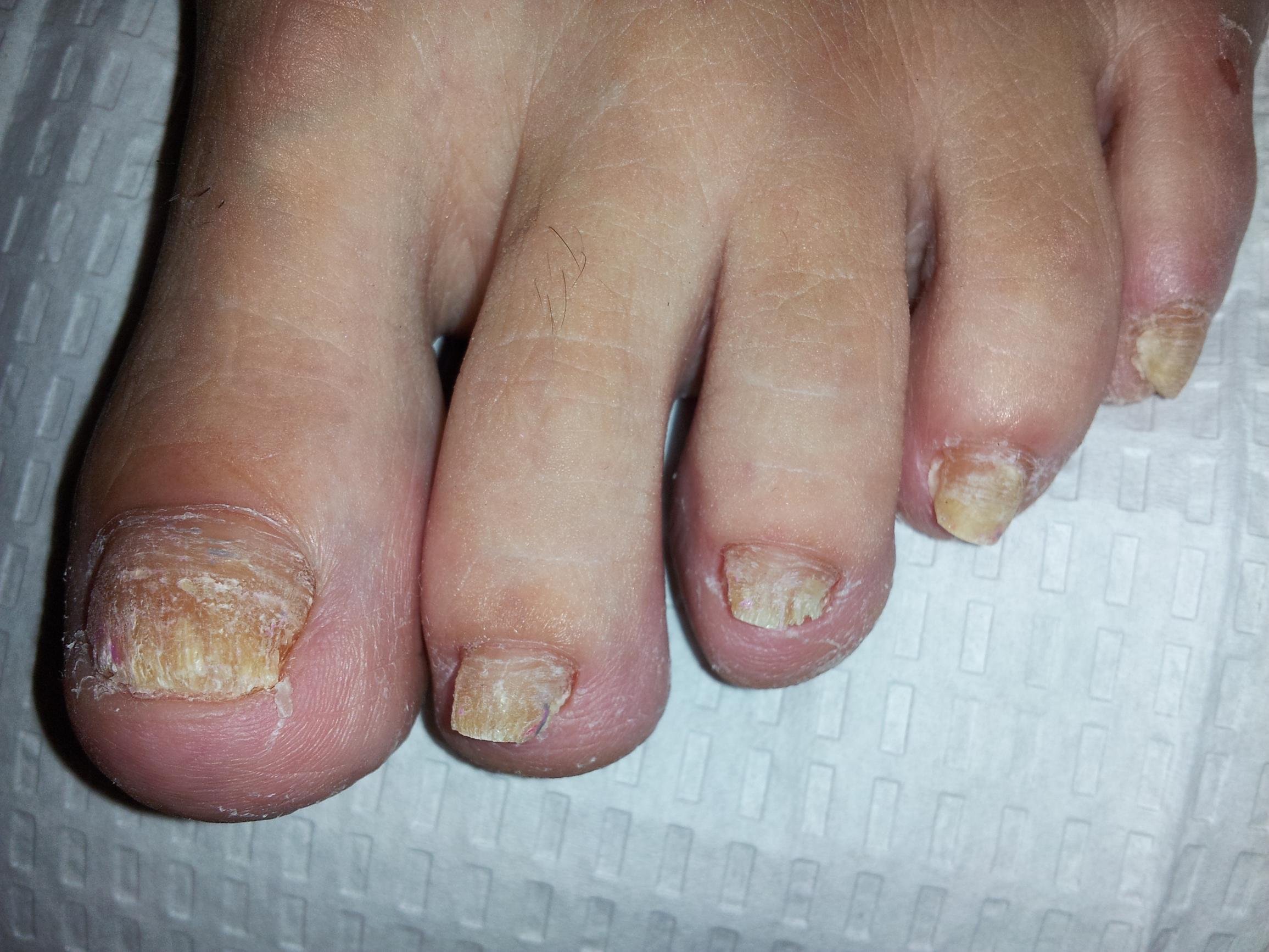 treatment of nail fungus with lamisil)