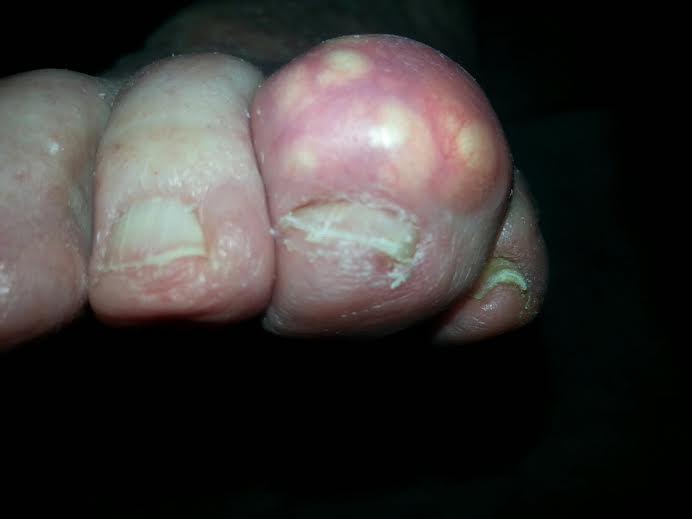 ... gout, big toe implant, big toe fusion, arthritis, big toe arthritis