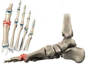 Painful big toe joint, hallux limitus, hallux rigidus, bunion, gout ...