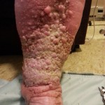 Swelling Feet