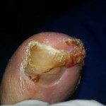 Services, Ingrown Nail,Ingrown Nails