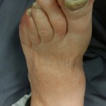 Foot Circulation,Swelling Feet