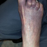 Venous insuffisency, Foot Circulation