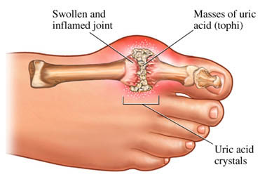 arthritis treatment, achy feet, foot pain, gout, pseudo gout, rheumatoid arthritis, pain joint, big toe joint pain, broken foot,