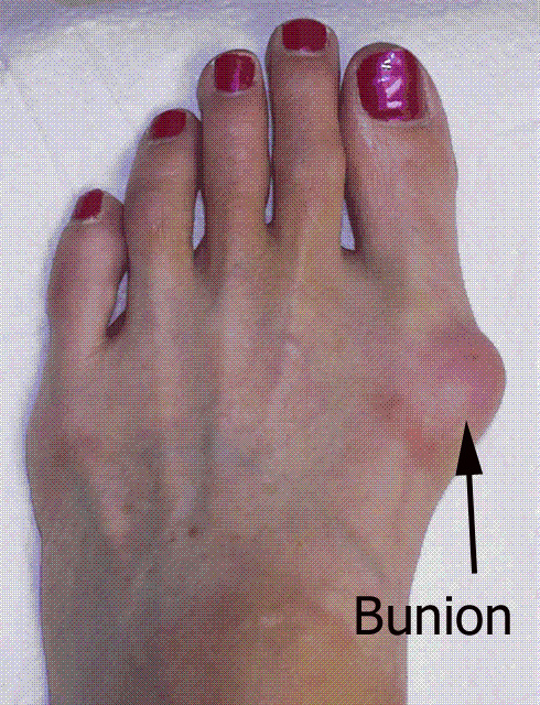 Bunions, westminster podiatrist, denver podiatrist, colorado podiatrist, arvada podiatrist, foot pain