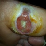 Foot Ulcer
