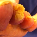 Painful Toe Corn, Toe Corns, corn, toe callus, thick skin on toe, soft corn, hard corn, heloma molle, heloma dura, toe pain, sore toe, hammer toe, hammertoe, crest pad, toe separator, arthritis toe, arthritic toe