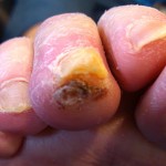 Painful Toe Corn, Toe Corns, corn, toe callus, thick skin on toe, soft corn, hard corn, heloma molle, heloma dura, toe pain, sore toe, hammer toe, hammertoe, crest pad, toe separator, arthritis toe, arthritic toe