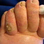 Toe Corns, corn, toe callus, thick skin on toe, soft corn, hard corn, heloma molle, heloma dura, toe pain, sore toe, hammer toe, hammertoe, crest pad, toe separator,