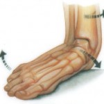 Structural Foot Problems, flat foot, pes planus, falling arch, arch, foot pain, heel spur, back pain