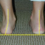 flat foot, pes planus, falling arch, arch, foot pain, heel spur, back pain