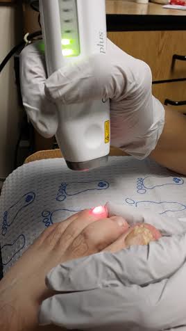 Laser nail, Laser treatment, laser nail fungus, laser genesis plus, laser toenail, Laser toenail fungus westminster, Podiatry 