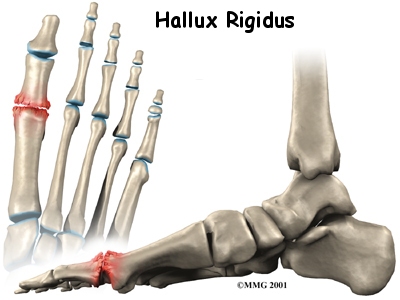 Foot Injuries in Sports, Foot Sports Medicine, Runner's Injuries, Running orthotics, Heel Pain, foot pain, painful heel, painful foot, painful feet in the morning, plantar fascitis, heel pain treatment, plantar fascitis treatment, orthotics, insoles, plantar fascitis, westminster podiatrist, broomfield podiatrist, denver podiatrist, orthotics, orthotics colorado, orthotics westminster, orthotics denver, custom orthotics, custom orthotics denver, custom orthotics colorado