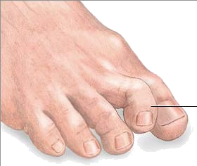 Painful Toe Corn, Toe Corns, corn, toe callus, thick skin on toe, soft corn, hard corn, heloma molle, heloma dura, toe pain, sore toe, hammer toe, hammertoe, crest pad, toe separator,