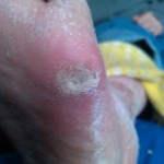 Calluses and Warts, Calluses, Warts, Laser wart treatment, callus treatment, wart removal, laser wart removal, wart infection, thick skin, foot pain, IPK, porokeratosis