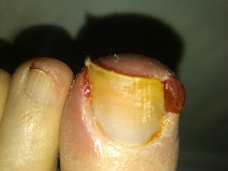 Ingrown Toenail, ingrown nails, Ingrown toenail treatment, painful nail, how to treat ingrown toenail, fix ingrown nail, nail infection, nail fungus, nail pain, hang nail,