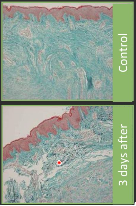 Laser Scar Reduction histology