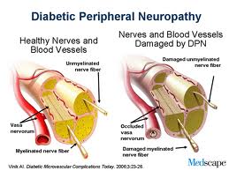 Peripheral Neuropathy, nerve pain, burning tingling feet, burning feet, tingling feet, painful feet, neuropathy,