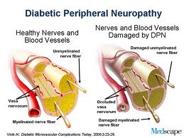 Diabetic Foot Care, peripheral neuropathy, peripheral vasular disease, PVD, ulcerations, amputation, diabetic amputation, diabetes, westminster podiatrist