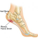 Structural Foot Problems, Heel Pain, foot pain, painful heel, painful foot, painful feet in the morning, plantar fascitis, heel pain treatment, plantar fascitis treatment, orthotics, insoles, plantar fascitis, westminster podiatrist, broomfield podiatrist, denver podiatrist