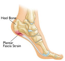 Heel Pain, foot pain, painful heel, painful foot, painful feet in the morning, plantar fascitis, heel pain treatment, plantar fascitis treatment, orthotics, insoles, plantar fascitis, westminster podiatrist, broomfield podiatrist, denver podiatrist