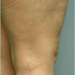 spider Vein Treatment, spider vein, vericose vein, veins in legs, treatment for spider veins, spider vein treatment denver, spider vein treatment colorado,