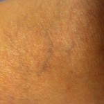 Laser Spider Vein Treatment, spider Vein Treatment, spider vein, vericose vein, veins in legs, treatment for spider veins, spider vein treatment denver, spider vein treatment colorado,