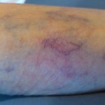 spider Vein Treatment, spider vein, vericose vein, veins in legs, treatment for spider veins, spider vein treatment denver, spider vein treatment colorado,