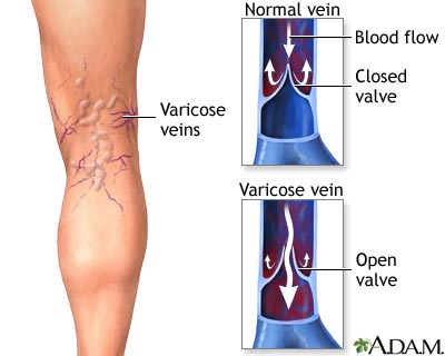 Varicose-Vein-Valves