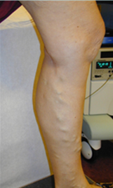 laser spider Vein Treatment, spider vein, vericose vein, veins in legs, treatment for spider veins, spider vein treatment denver, spider vein treatment colorado,