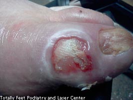 Diabetic Foot Care, peripheral neuropathy, peripheral vasular disease, PVD, ulcerations, amputation, diabetic amputation, diabetes, westminster podiatrist, Peripheral vascular disease, PVD, vascular, ulcer, vascular ulcer, amputation