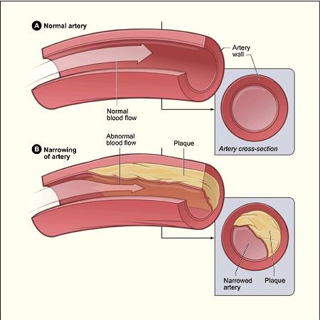 peripheral vascular disease, PVD, PAD, periperal artery disease, 