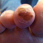 Painful Toe Corn, Toe Corns, corn, toe callus, thick skin on toe, soft corn, hard corn, heloma molle, heloma dura, toe pain, sore toe, hammer toe, hammertoe, crest pad, toe separator, arthritis toe, arthritic toe