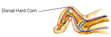 Toe Corns, corn, toe callus, thick skin on toe, soft corn, hard corn, heloma molle, heloma dura, toe pain, sore toe, hammer toe, hammertoe, crest pad, toe separator, arthritis toe, arthritic toe