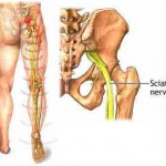 sciatica