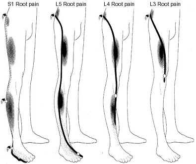 Can Sciatica Cause Foot Pain and Swelling?