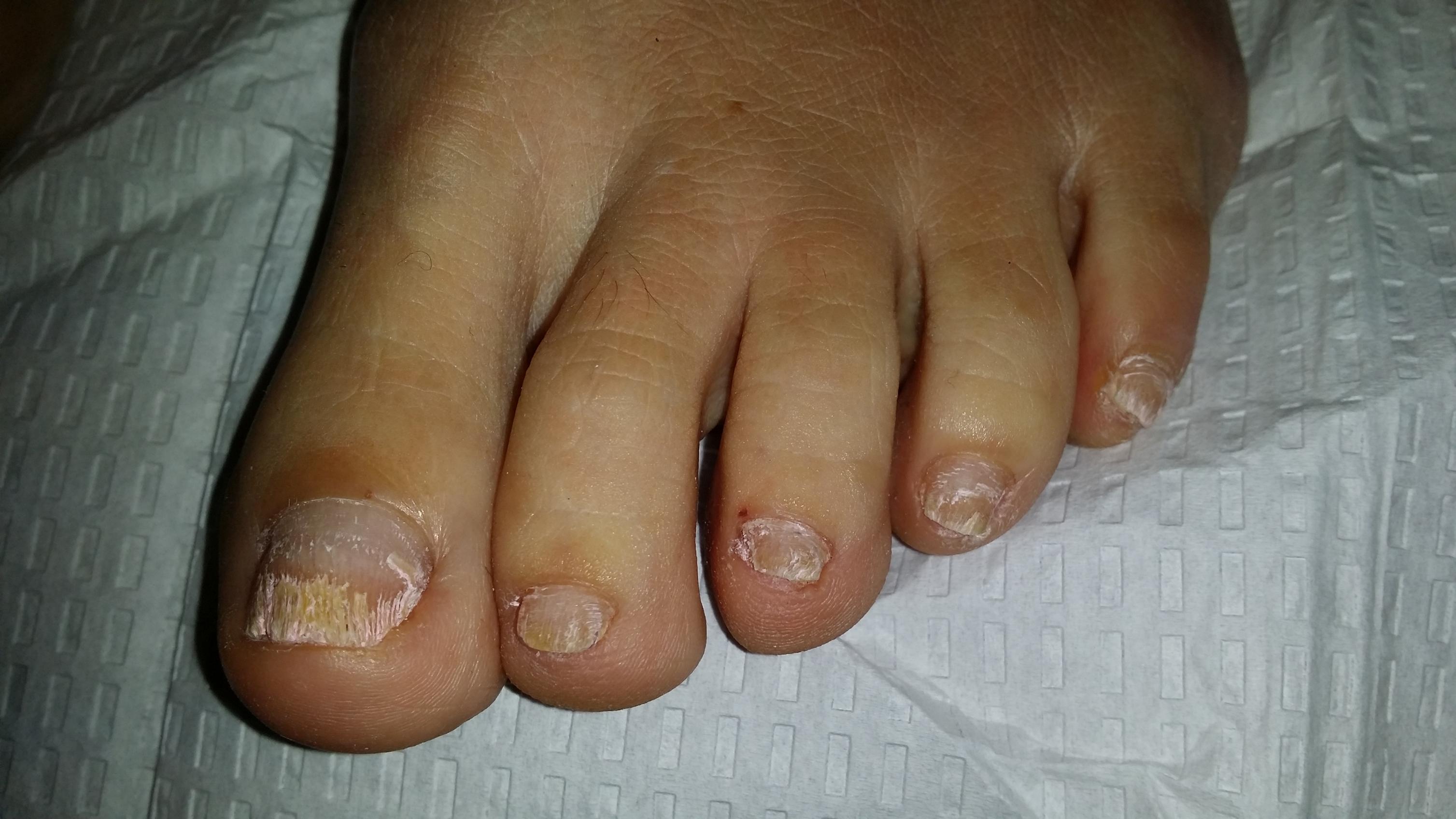 Laser Nail Fungus Treatments, Nail Fungus Treatment, laser nail, laser fungus westminster, nail infection, nail disease, Medication for nail fungus, Laser toenail, laser fingernail, fingernail infection, laser nail fungus westminster