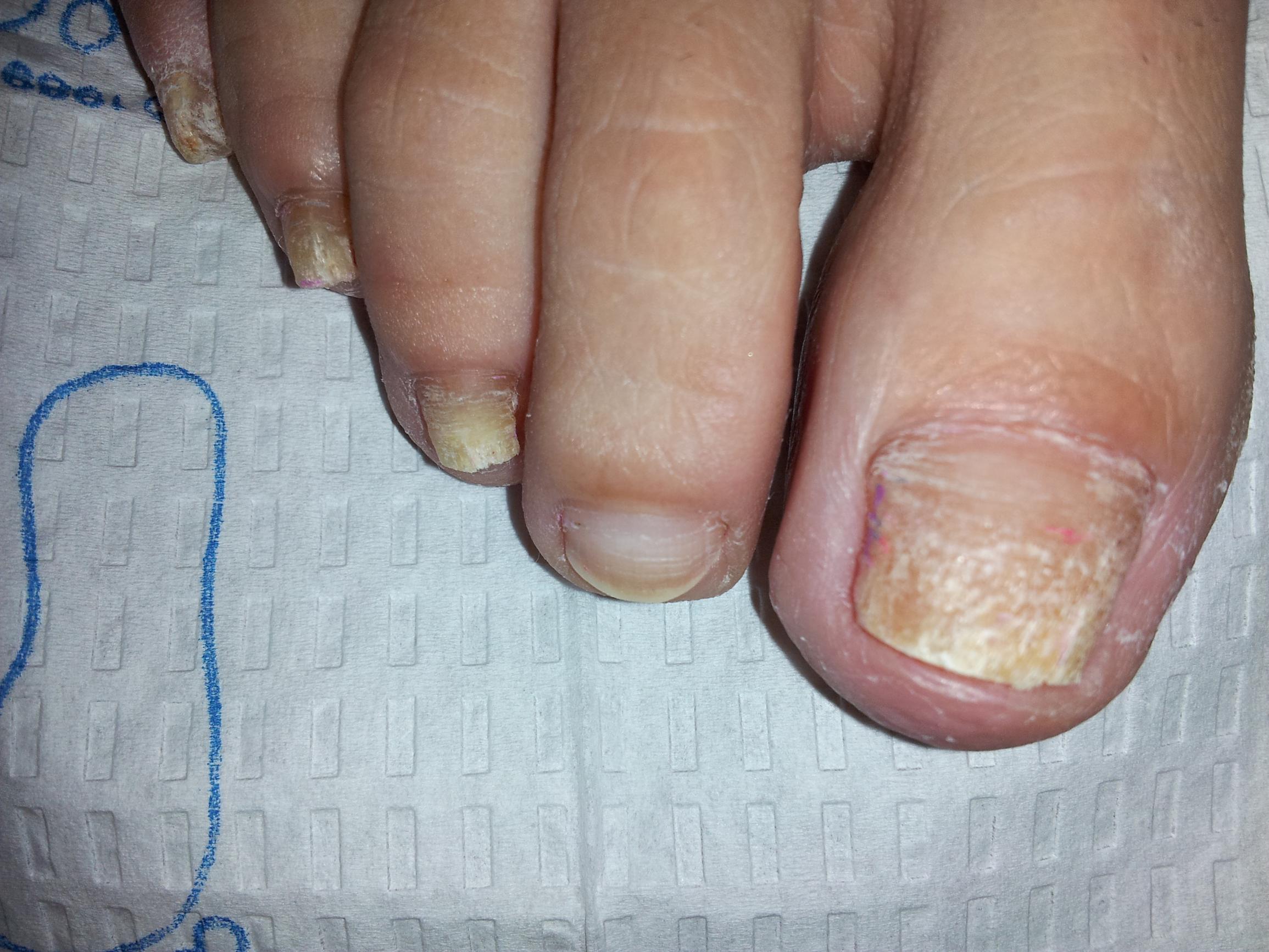 Laser Nail Fungus Removal, Laser Nail Fungus Treatments, Nail Fungus Treatment, laser nail, laser fungus westminster, nail infection, nail disease, Medication for nail fungus, Laser toenail, laser fingernail, fingernail infection, laser nail fungus westminster