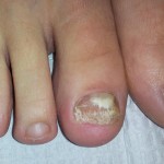 Laser Nail Fungus Treatments, Nail Fungus Treatment, laser nail, laser fungus westminster, nail infection, nail disease, Medication for nail fungus, Laser toenail, laser fingernail, fingernail infection, laser nail fungus westminster