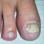 Laser Nail Fungus Treatments, Nail Fungus Treatment, laser nail, laser fungus westminster, nail infection, nail disease, Medication for nail fungus, Laser toenail, laser fingernail, fingernail infection, laser nail fungus westminster