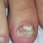 Foot Dermatology, dermatological, Laser nail, laser nail fungus, laser toe, laser toenail, laser fungus, laser finger, laser fingernail