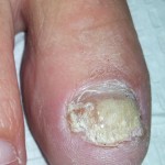 Foot Dermatology, Dermatological, Laser nail, laser nail fungus, laser toe, laser toenail, laser fungus, laser finger, laser fingernail