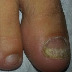 Foot Dermatology, Dermatological, Laser nail, laser nail fungus, laser toe, laser toenail, laser fungus, laser finger, laser fingernail