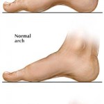 Structural Foot Problems, Foot Types, fitting shoes, fitting shoes high arched feet, edema, high arched feet, orthotics