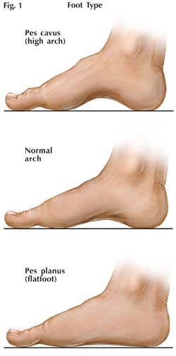Foot Types, fitting shoes, fitting shoes high arched feet, edema, high arched feet, orthotics